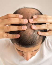 chute de cheveux